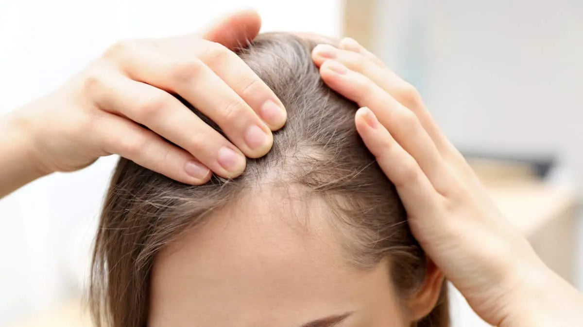 Haargroei stimuleren op kale plekken – 5 tips