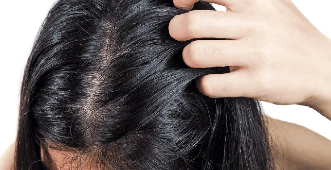 Geïrriteerde hoofdhuid behandelen met 5 onmisbare tips